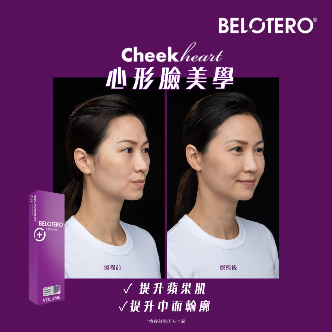 Belotero Volume