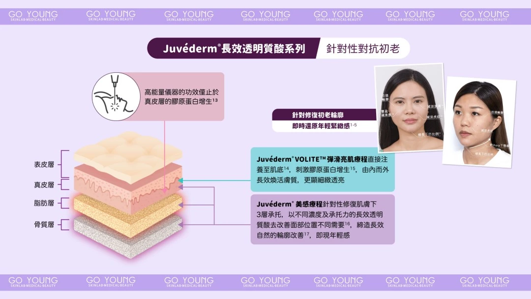 JUVÉDERM® VOLIFT(緹顏)