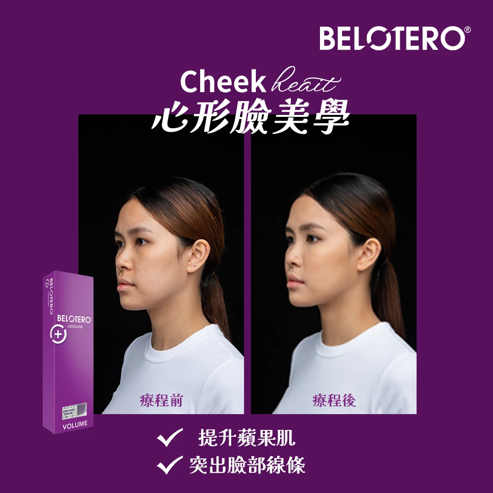 Belotero Volume